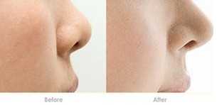 鼻尖整形——王小姐