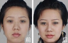 假體隆鼻——馬女士