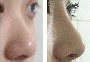 玻尿酸隆鼻——鄭小姐