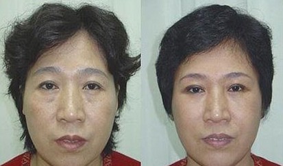 面部除皺——柳女士