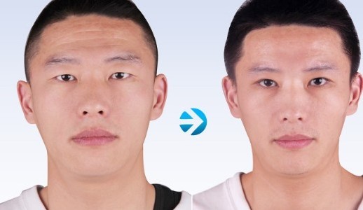 伊維蘭注射除皺——王先生