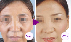 脂肪干細(xì)胞面部種植——劉女士