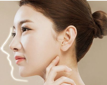 假體隆鼻-林賢超