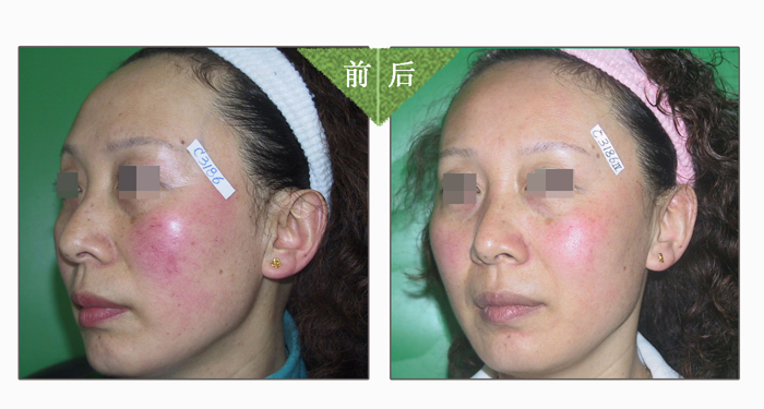 祛紅血絲——楊女士