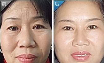 去皺美容——林女士