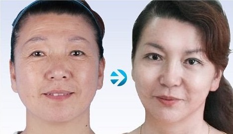 注射除皺——葉女士