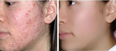 激光祛痘——王小姐