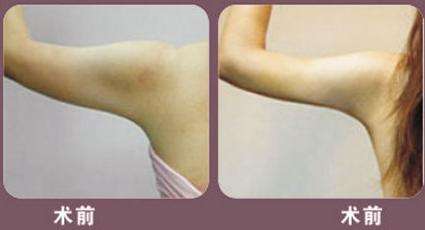 手臂吸脂5-林賢超