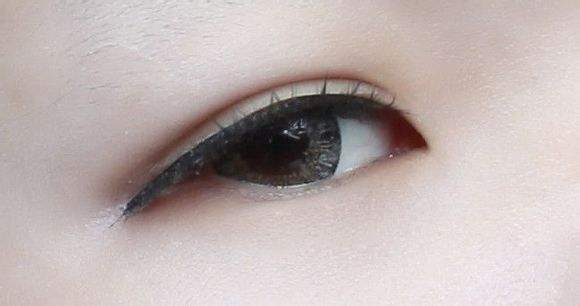 割雙眼皮-林賢超醫(yī)生