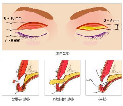 雙眼皮術(shù).jpg