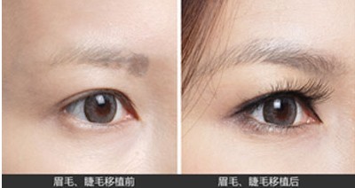 睫毛移植——莊小姐