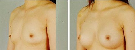 假體隆胸——林女士