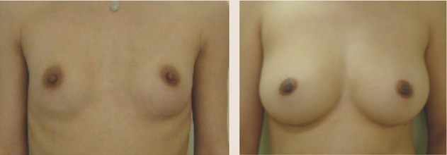 麥格假體隆胸——劉女士