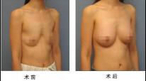 假體隆胸——謝小姐
