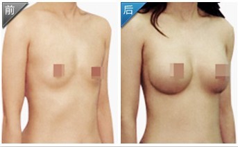 隆胸失敗修復(fù)——王女士