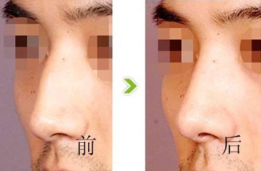 隆鼻失敗修復(fù)——李先生