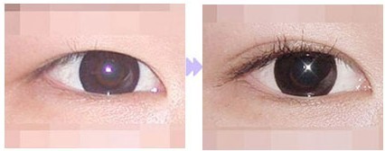 雙眼皮手術(shù)——張小姐