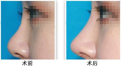 注射隆鼻.jpg