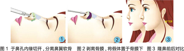 假體隆鼻示意圖